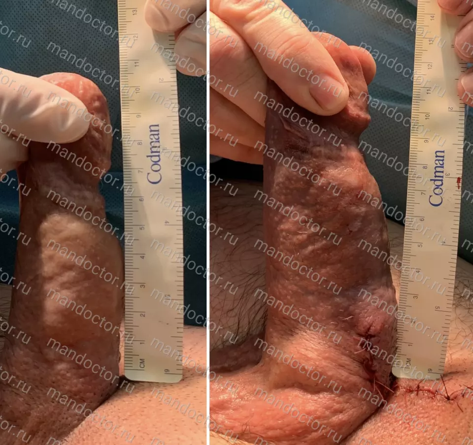 Patient photo, result of penis elongation surgery