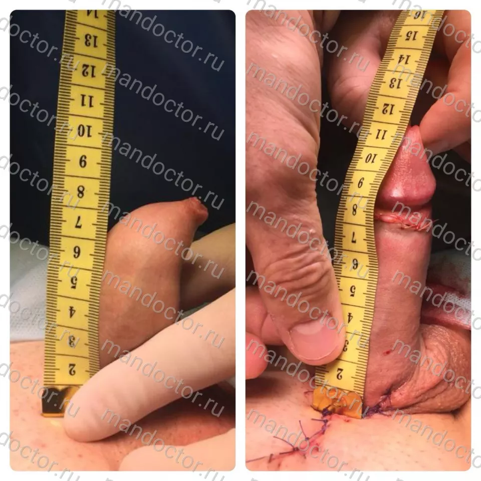 The erected penis before and immediately after the operation Mod.LT