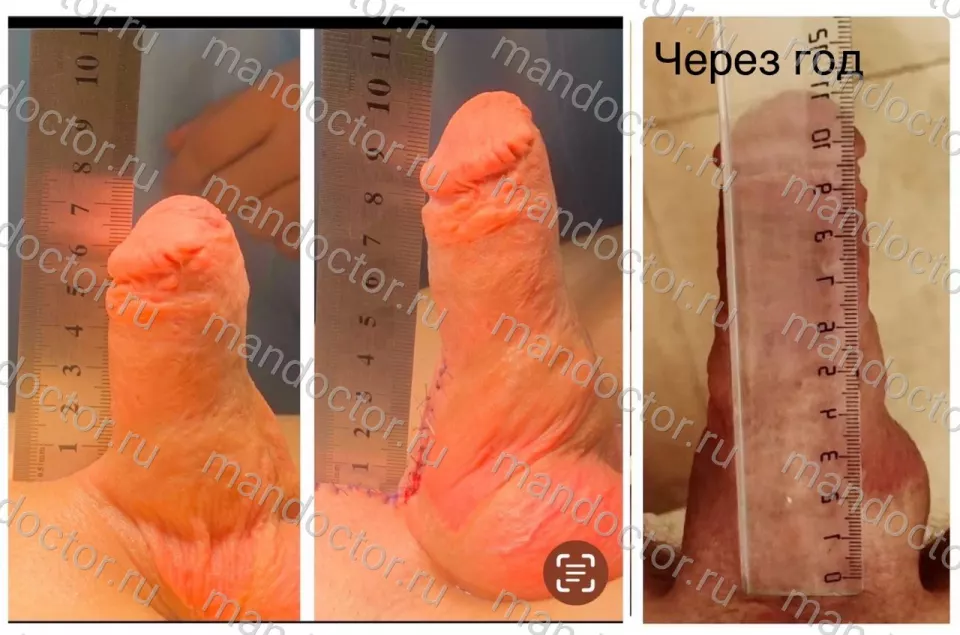 The erected penis before, immediately after, and one year after the operation Mod.LT