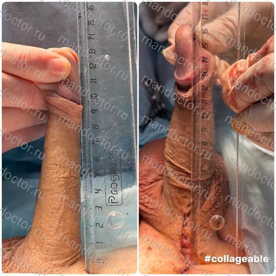 Patient photo, result of penis elongation surgery