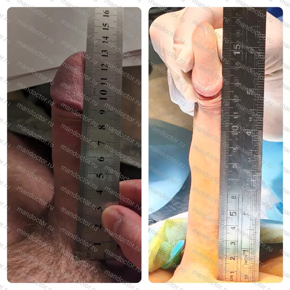 Penile lengthening by corporoplasty with graft without intracavernous prosthetics