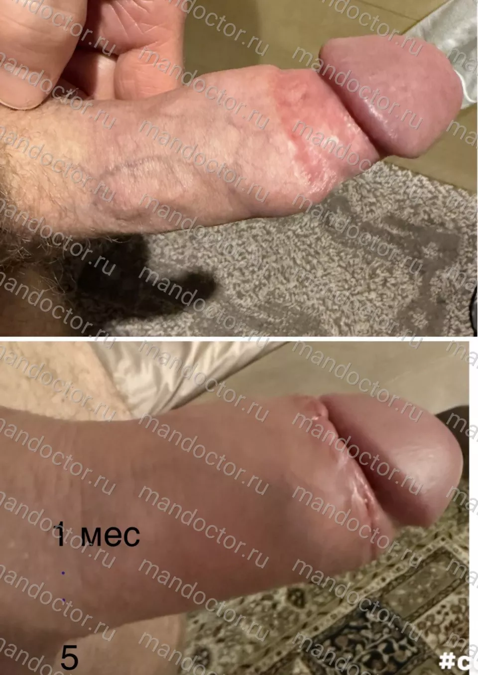 The appearance of the penis before and one month after thickening with a silicone implant. The unevenness of the organ's contour before the surgery due to the remnants of previously injected fillers