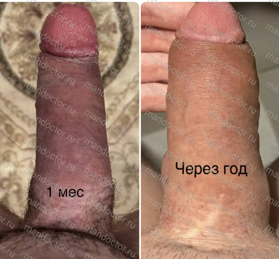 The appearance of the penis after subcutaneous thickening with a permanent silicone implant one month and one year after surgery. There is a significant increase in the volume of the penis due to the growth of the capsule around the implant and the improvement in the blood flow to the cavernous bodies of the penis.