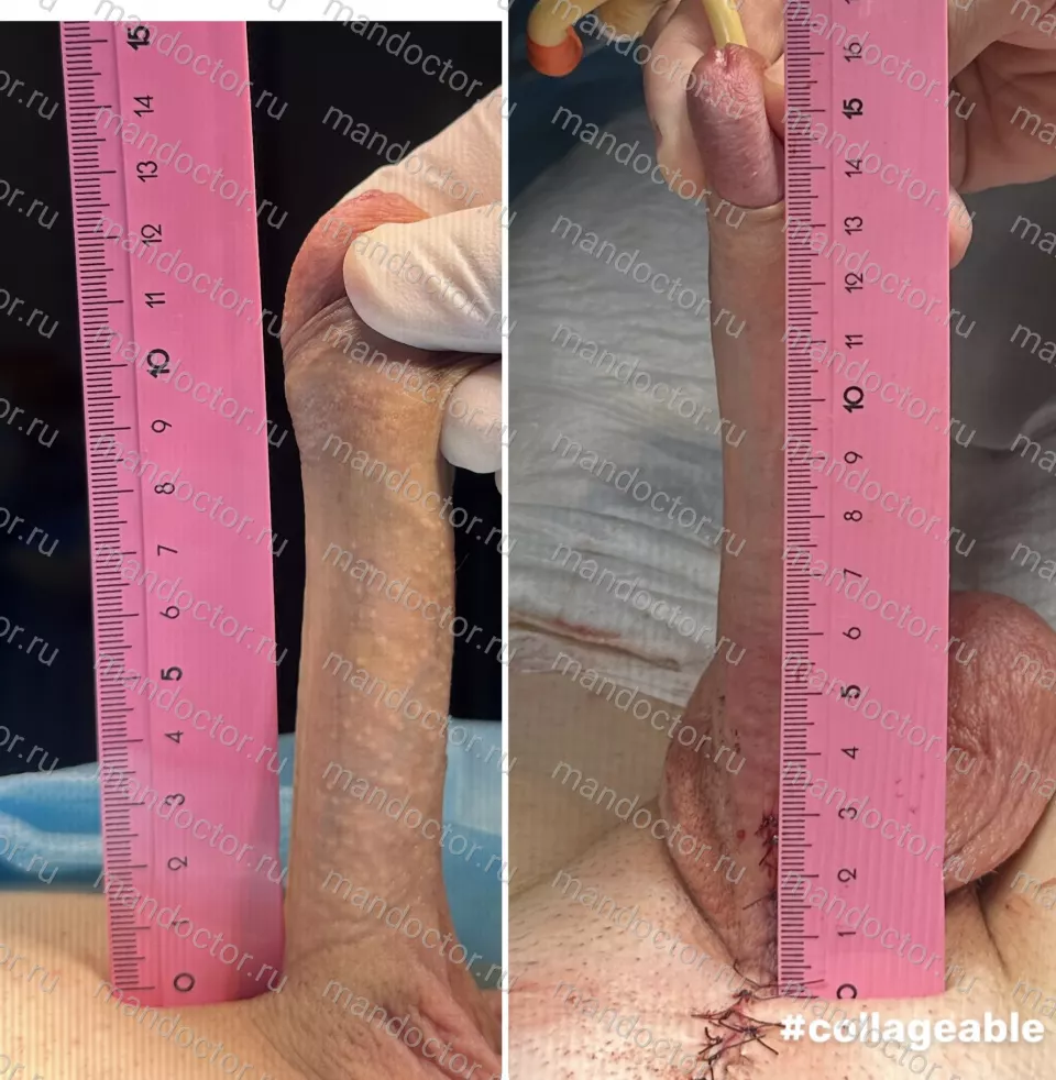 Patient photo, result of penis elongation surgery