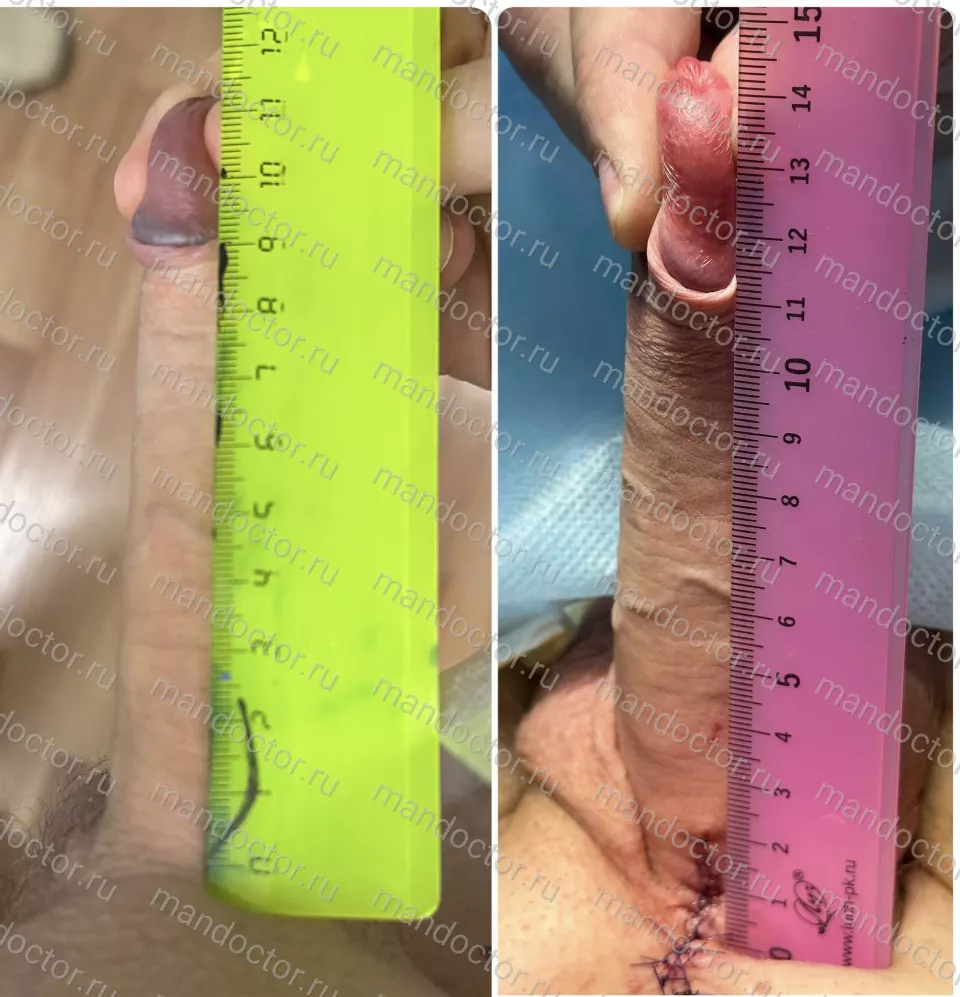 Patient photo, result of penis elongation surgery