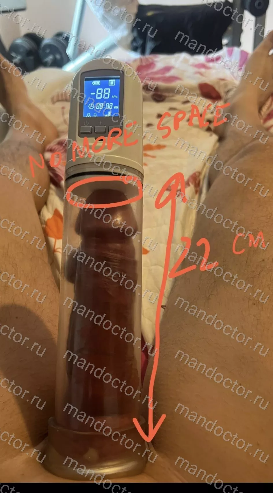 Excellent continued penile elongation for 6 months after surgery.