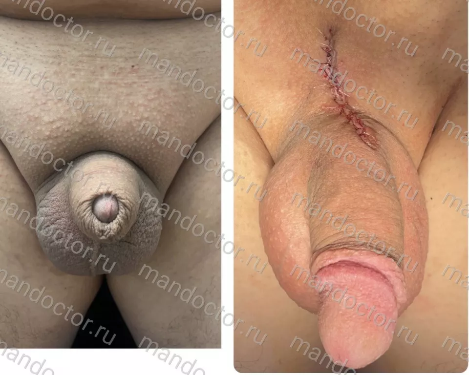 An erect penis before and immediately after Mod.LT + pubic lipectomy surgery.