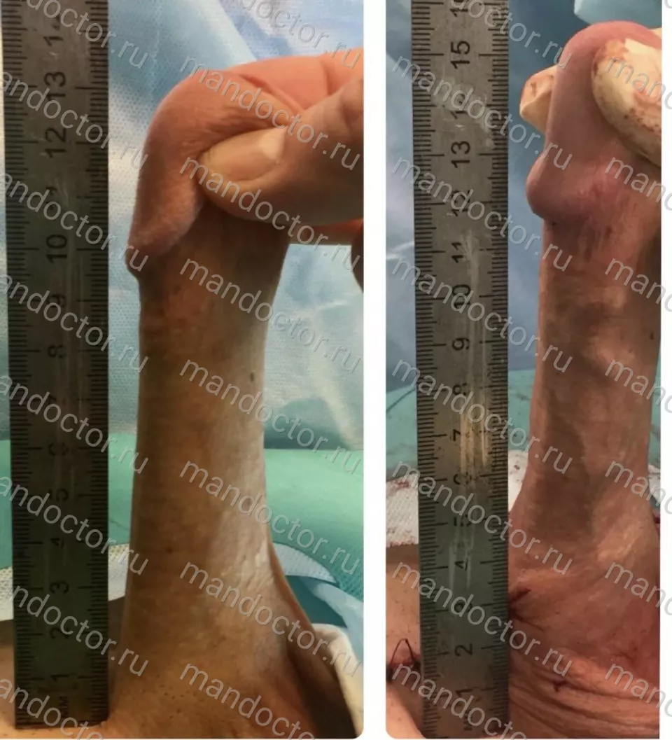 Patient photo, result of penis elongation surgery
