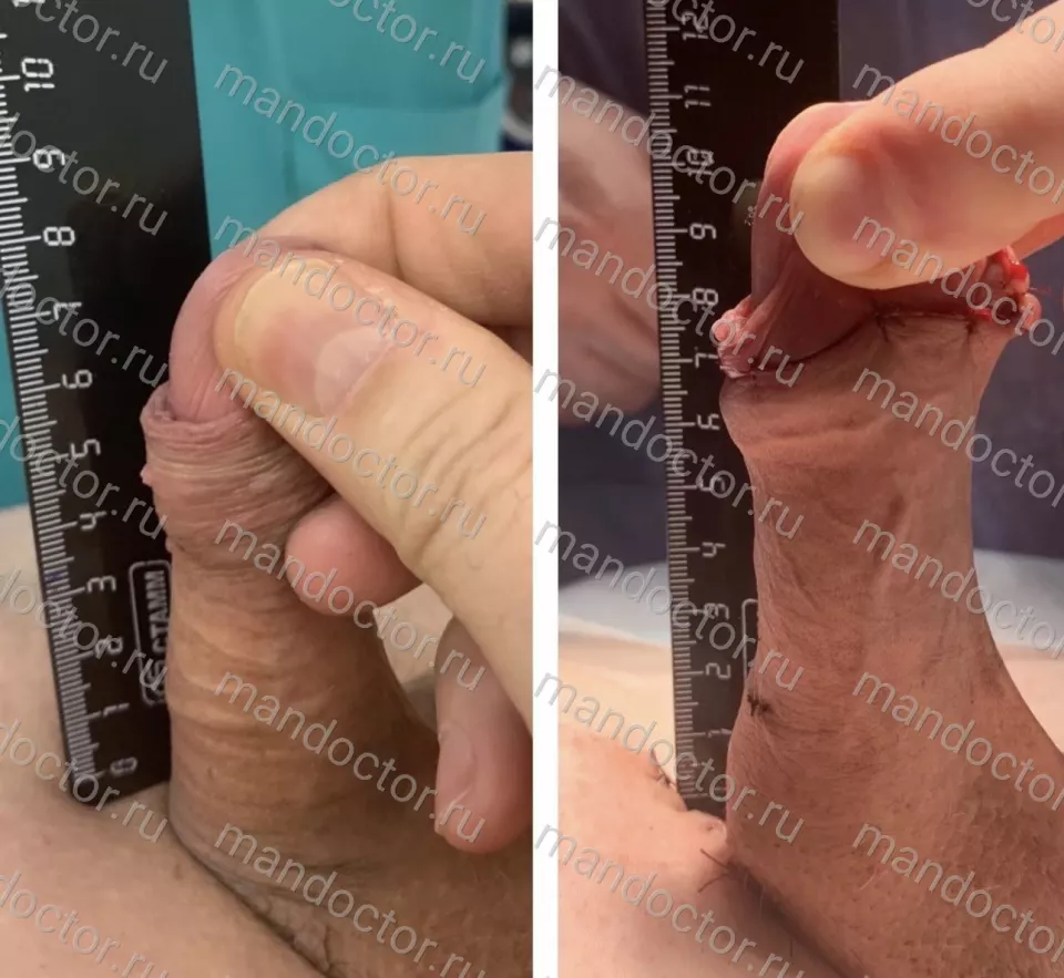 Patient photo, result of penis elongation surgery