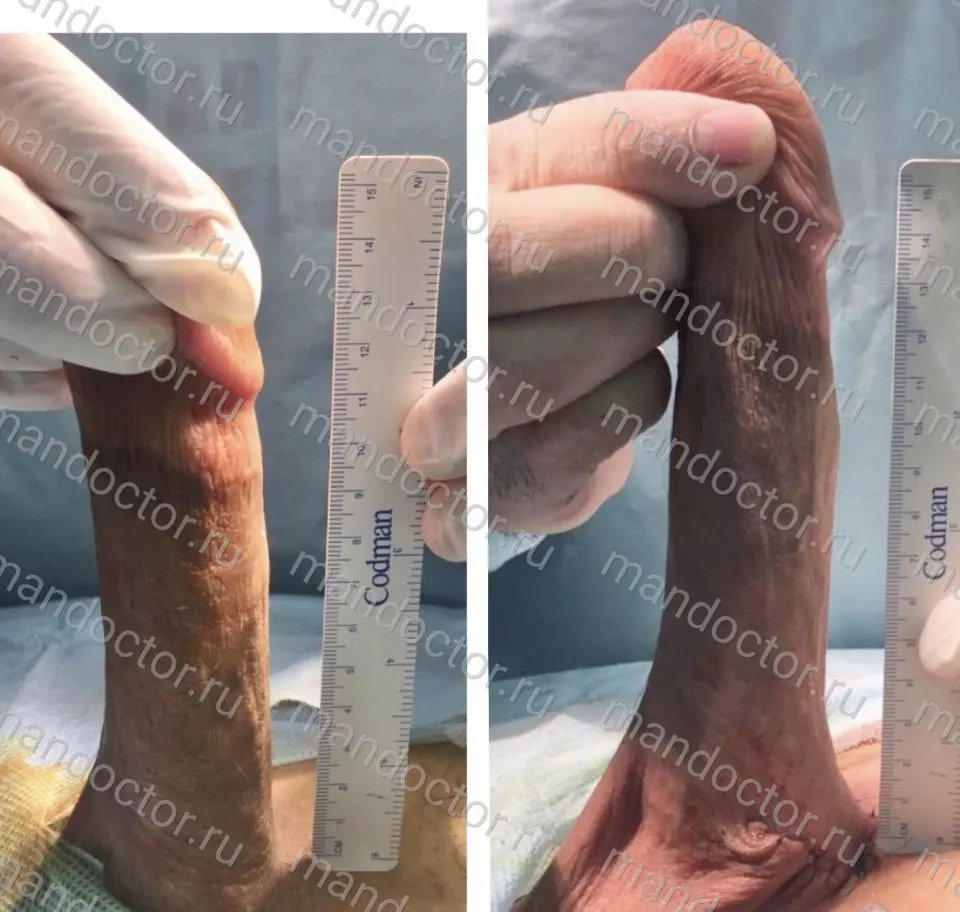 Patient photo, result of penis elongation surgery