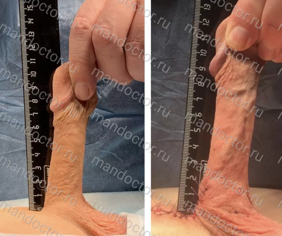 Patient photo, result of penis elongation surgery