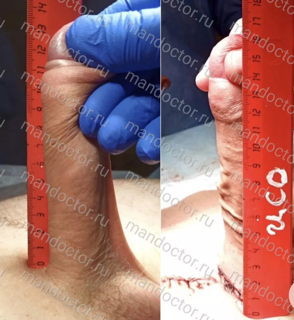 Patient photo, result of penis elongation surgery