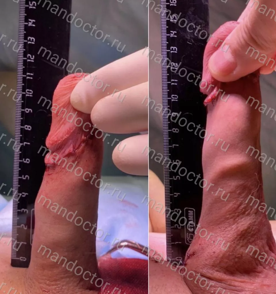 Patient photo, result of penis elongation surgery
