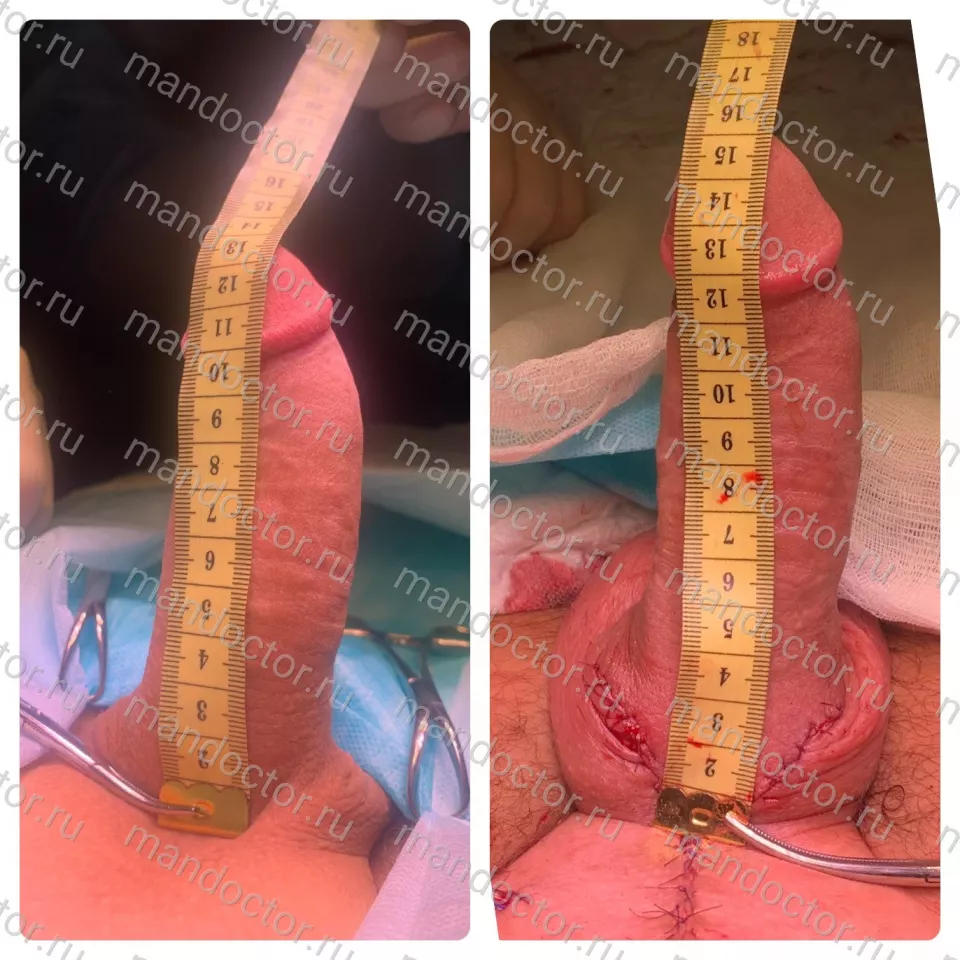 The erected penis before and immediately after operation Mod.LT