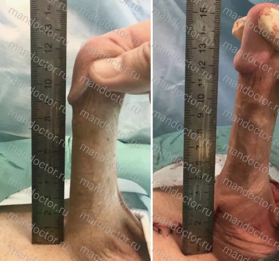 Patient photo, result of penis elongation surgery