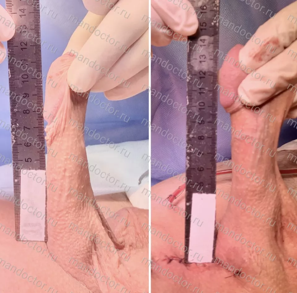 Patient photo, result of penis elongation surgery