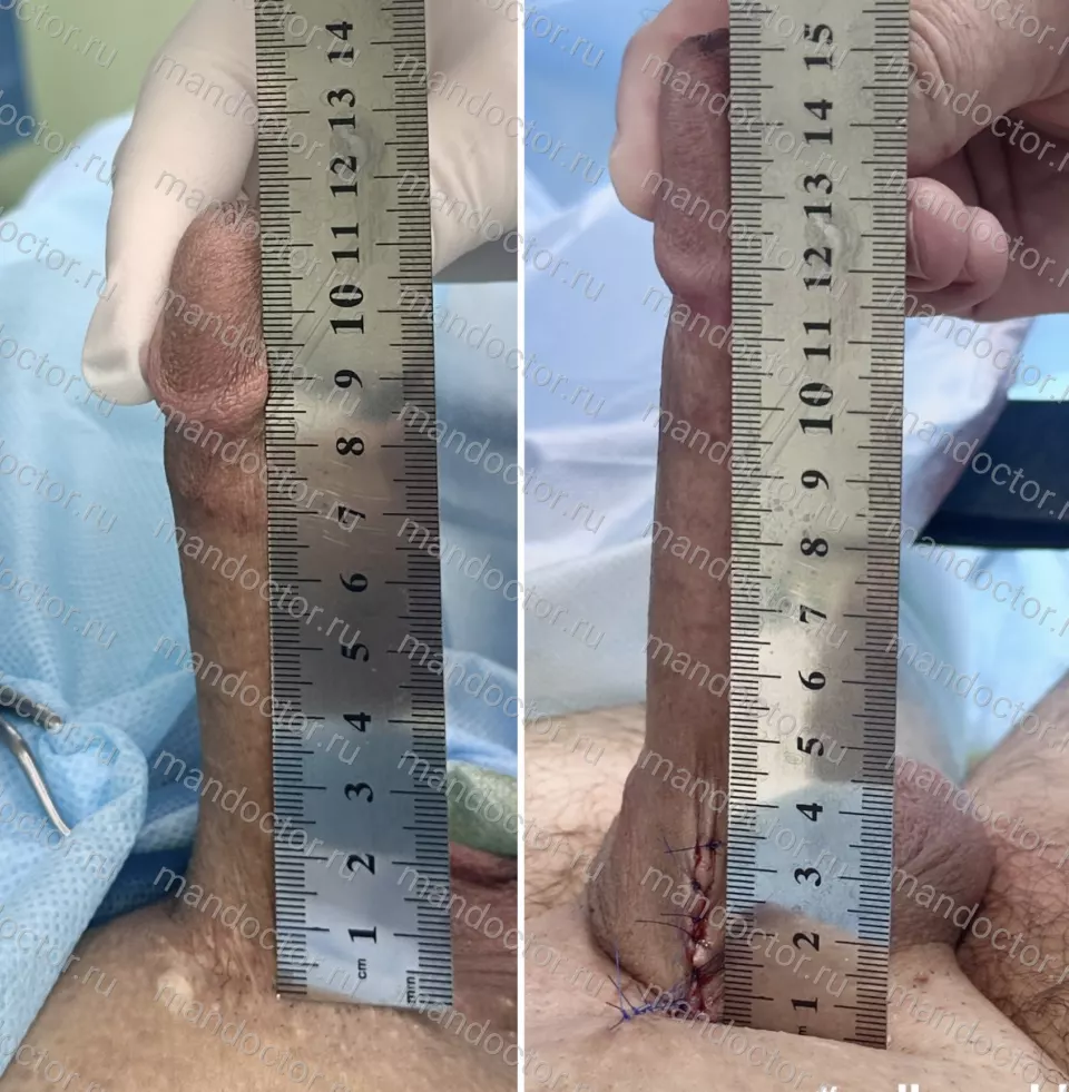 Patient photo, result of penis elongation surgery