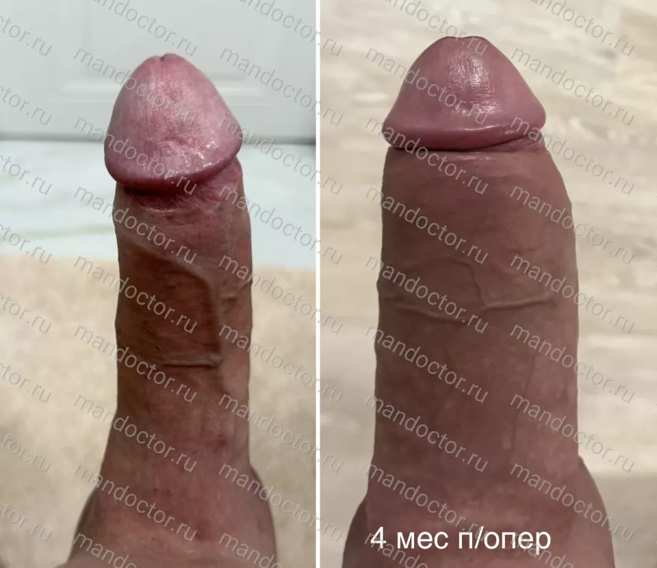 Вид ПЧ в состоянии эрекции до и через 4 мес после утолщения силиконовым имплантом