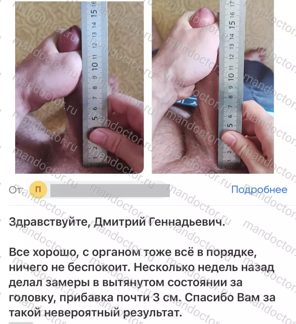 The stretched penis before and 2 months after Mod.LT surgery.
